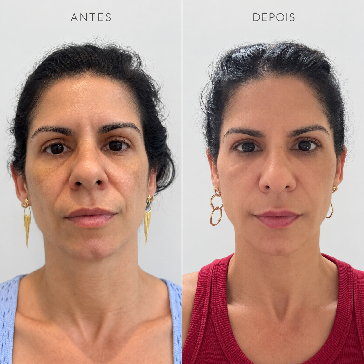 Comparativo real 4 de antes e depois de rejuvenescimento facial em Mogi das Cruzes